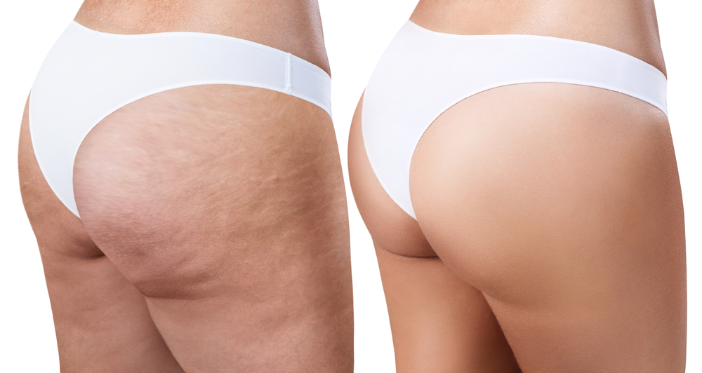 Cellulite Reduction | Better Body, Inc
