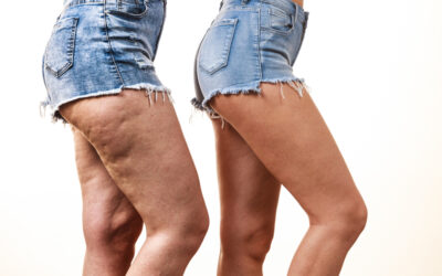 FROM BOOTY TO THIGHS: INVESTIGATING THE TRIGGERS OF CELLULITE